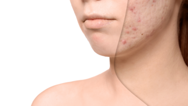 Acne scars treatment